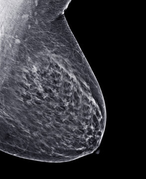 X-ray Digital Mammogram or mammography of both side breast Standard views are  mediolateral oblique (MLO) views .