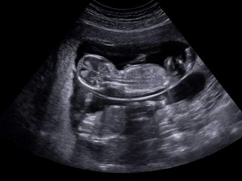 An ultrasound x-ray of a baby in the womb