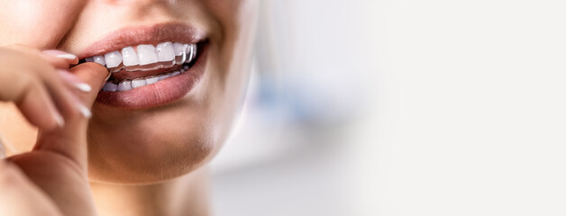 A woman puts on an invisible silicone teeth aligner. Dental braces for teeth correction - obrazy, fototapety, plakaty