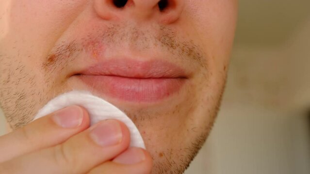 Man with herpes on lips against light grey background. Cold sore on a man lips. Sore virus concept. Man treat sore by cotton disk with antiseptic to prevent spreading of virus on the other parts of