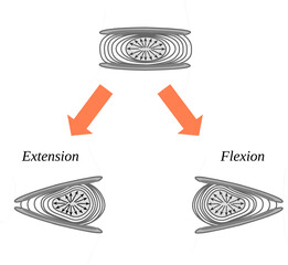 Deformation of the intervertebral disc due flexion and extension motion