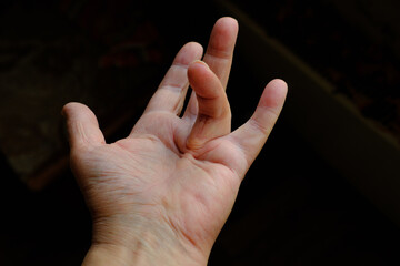 Hand of a person with Dupuytren's contracture, which does not allow to bend the finger. High quality photo