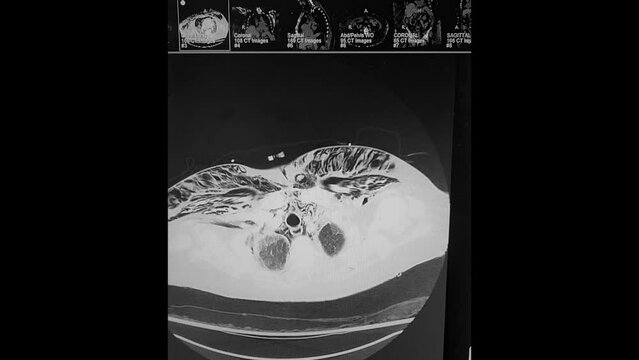 CT Chest - pneumomediastinum and subcutaneous emphysema w interstitial pneumonia