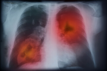 X-ray image of patient with lung cancer. Illustration