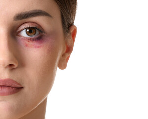 Young woman with bruise under eye on white background, closeup