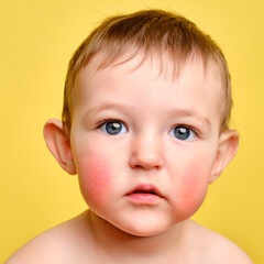 Sad toddler baby with allergies on her face, studio yellow background. Portrait of an unhappy...