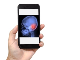 Doctor woman hand holding smartphone has X-ray skull with cerebral vascular accident (CVA) on white background. Medical and healthcare concept