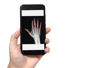Doctor woman hand holding smartphone has rheumatoid arthritis , Gout arthritis ( Film x-ray both hands with multiple joint arthritis ) on white background. Medical and healthcare concept.
