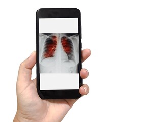Doctor woman hand holding smartphone has tuberculosis chest x-ray image content on white background. Medical and healthcare application concept. Copy space