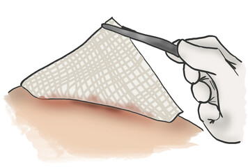 Wound care nursing clipart of bandage dressing change in comic style on transparent background