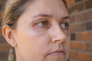 Double Eyelid Surgery, Eyes Surgery Recover Period, immediately after plastic surgery. Eyes After Eyelid Surgery