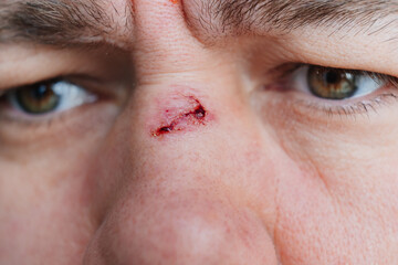 Fototapeta premium close-up. bloody abrasion on the bridge of the nose of a man after a blow. 