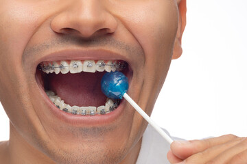 Hispanic man with brown skin, bites a palette of sweet blue color with his braces, misuse of orthodontics