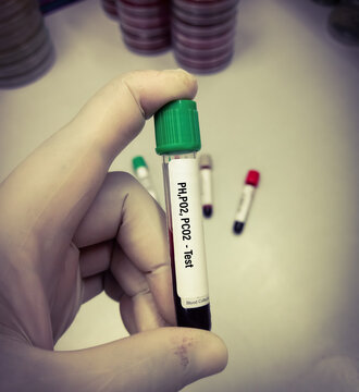 Blood Sample For PH, PO2 (partial Pressure Of Oxygen) And PCO2 (partial Pressure Of Carbon Dioxide) Test, Laboratory Background.