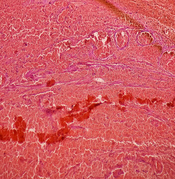 Ovarian Cyst: Haemorrhagic Cyst. Microscopic Show Ovarian Cyst Wall Of Fibrocollagenous Tissue And Lined By Layers Of Haemosiderin-laden Macrophages With Blood, Benign Tumor.