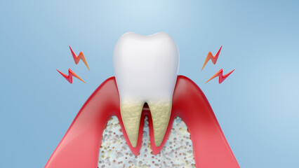 Dental health and gum disease. 3D rendering.