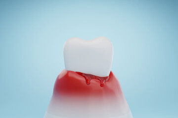 Bleeding gums and gum disease. Dental health and gingivitis concept. 3D rendering.