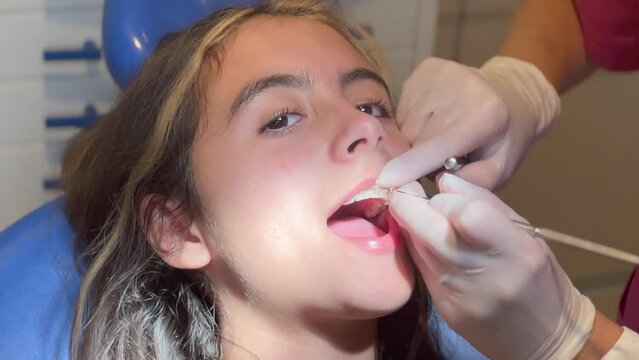 Closeup Braces on Teeth with Elastics. Orthodontic Treatment. Front View Dental Brackes