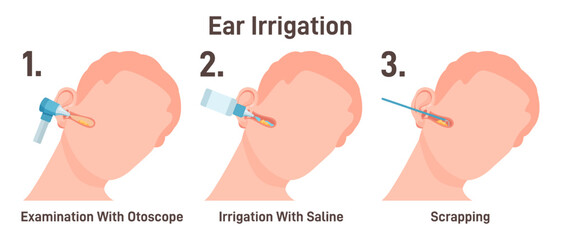 ENT doctor irrigate ears. Doctor checking ear canals, removing