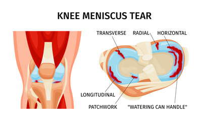 Knee Meniscus Tear Infographics