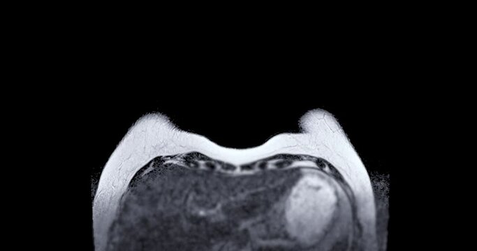 Breast MRI magnetic resonance imaging of the breast uses radio waves and strong magnets to make detailed pictures of the inside of the breast To screen for breast cancer.