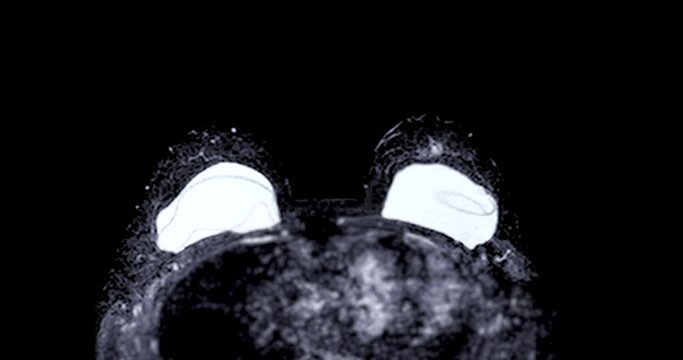 Breast MRI magnetic resonance imaging of the breast uses radio waves and strong magnets to make detailed pictures of the inside of the breast To screen for breast cancer.