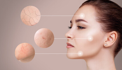 Magnifying circles shows skin problems of young woman.