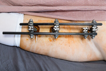 top view of external fixation device on hip and pelvic in patient with pelvic fracture (focus on...