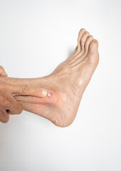Skin blisters that are ulcerated on the feet of an elderly person