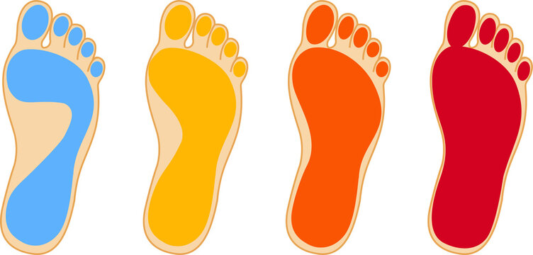Stages of flat feet