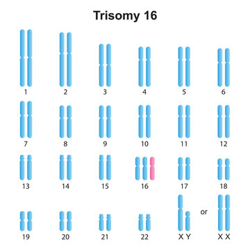 Scientific Designing of Mosaic Trisomy 18 Karyotype. Colorful Symbols. Vector Illustration.
