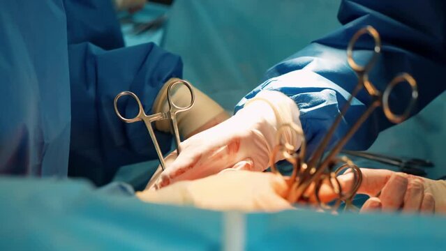 Surgeons in the operating room perform an operation on a patient. A complex surgical operation. The nurse hands the surgeons a scalpel and other surgical items