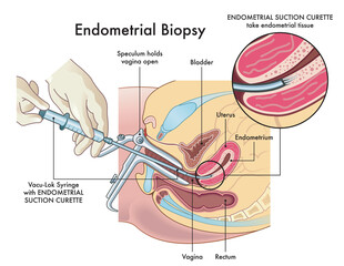Medical illustration  of the endometrial biopsy procedure with annotations.