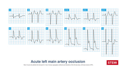 Acute left main artery occlusion can cause both ST segment elevation and non ST segment elevation myocardial infarction, regardless of which type, the risk of death is high.