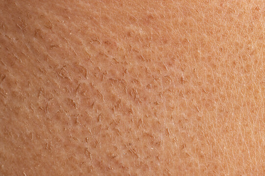 Peeling Of The Skin After An Allergic Rash