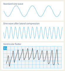 Ventricular flutter is a fatal ventricular tachyarrhythmia, which resembles a sine wave after squeezing, and cannot distinguish between QRS waves and T waves.