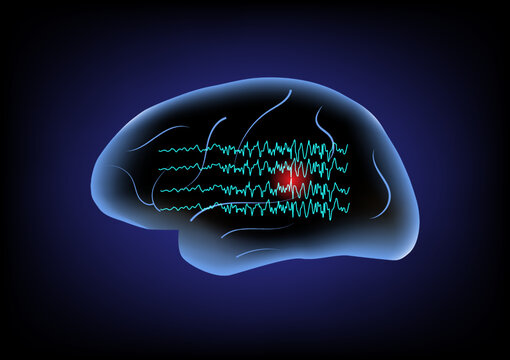 Illustration of human brain and brain waves. Concept of focal seizure.