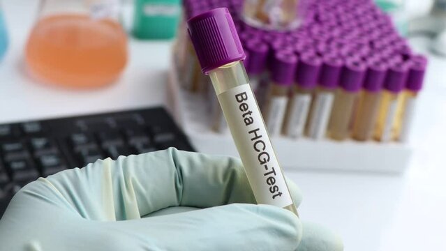 Urine samples for testing HCG in the laboratory, urine sample in test tube