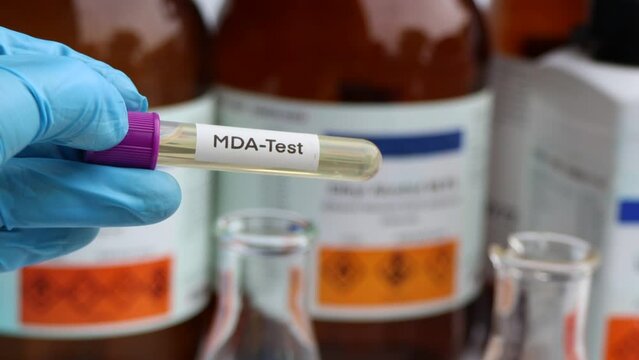 Urine samples for testing MDA in the laboratory, urine sample in test tube