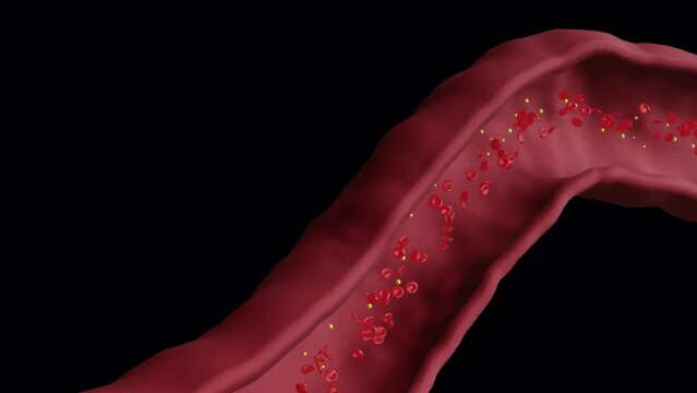 Cholesterol Buildup in Blood Vessel (cross-section) - AlphaBG