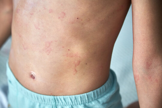 Food Allergy. A Boy With Red Spots. The Child Has Itching, With An Allergic Rash..