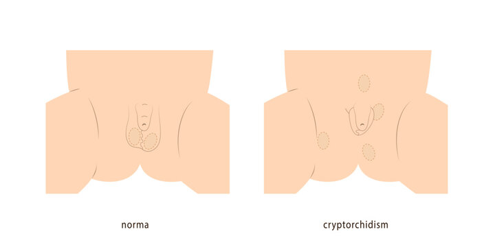 Medical illustration of little boy scrotum healthy and with undescended testicles demonstrating possible location of testicles.