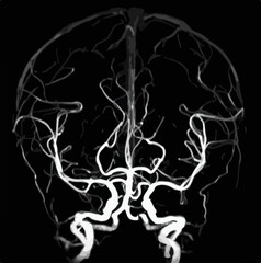 MR angiogram of cerebral arteries. - obrazy, fototapety, plakaty