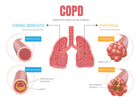 Epoc infographic: manifests itself in two forms emphysema and bronchitis 
