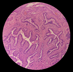 Cholelithiasis of Gallbladder, microphotograph of chronic cholecystitis, show perimuscular fibrosis...