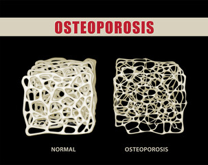 3D illustration comparing osteoporosis with normal bone on black background. medical use Education...