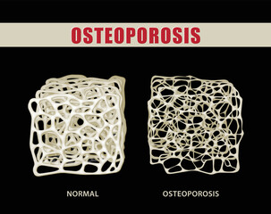 3D illustration comparing osteoporosis with normal bone on black background. medical use Education and Commerce