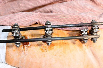 view of external fixation device on hip and pelvic in patient with pelvic fracture (focus on upper...