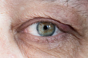 Fototapeta premium inflamed male eye with chalazion on eyelid from close up