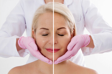 Closeup woman middle age face before after collagen face injection. Wrinkle anti aging concept....